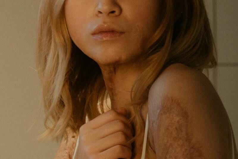 What’s the Average Burn Injury Settlement—and Why That Number Doesn’t Really Exist
